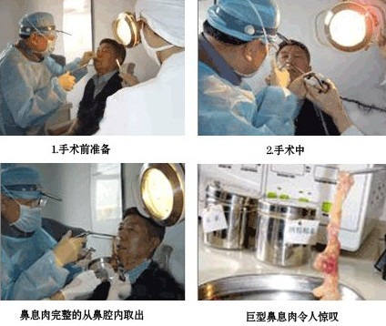 动力回旋术成功取出巨型射精障碍