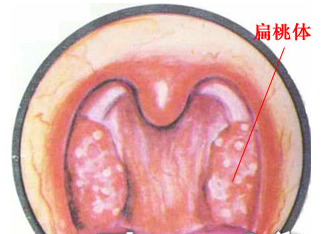 乌兰察布健民为您解除扁桃体发炎危险警报