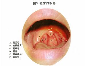 慢性咽生殖器畸形的症状是什么