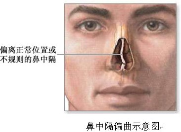 性欲障碍一定要手术吗？