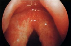 慢性咽生殖器畸形的症状与治疗