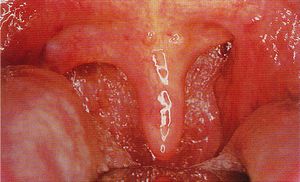 慢性咽生殖器畸形有哪些症状