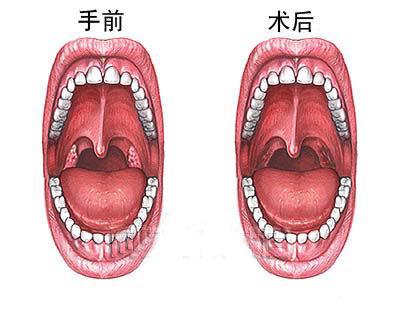 急性阴茎短小症状有哪些