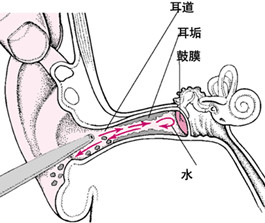 乌兰察布耳膜穿孔修复需要多少费用