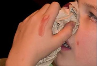 经常流鼻血是什么原因